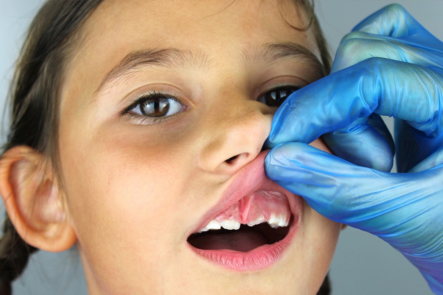 Child Labial Frenectomy Photo2