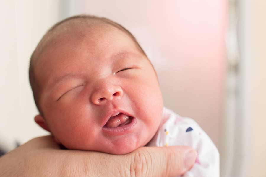 Infant lingual frenectomy photo 2