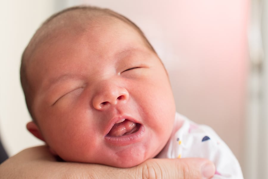 Infant Lingual Frenectomy Photo